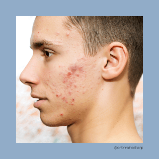 Moderate cystic acne on a face side profile